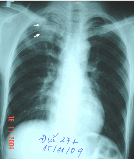 Hình ảnh u đỉnh phổi phải (mũi tên dưới) & hình ảnh liềm hơi (mũi tên trên) ở bệnh nhân nam, 27 tuổi U nấm phổi  aspergillus