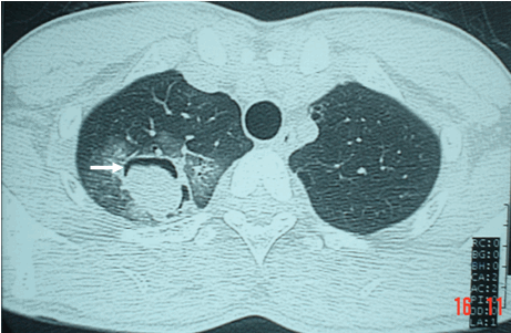 Hình ảnh u nấm phổi có liềm hơi trren phim chụp CT ngực ở bệnh nhân nam 27 tuổi U nấm phổi aspergillus