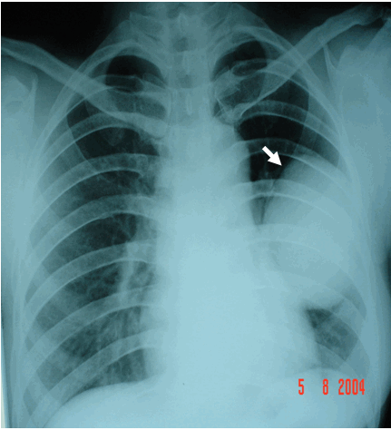 U nang nước phổi phải có ranh giới rất rõ trên phim chụp phổi chuẩn