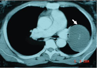  Hình ảnh khối u tròn có ranh gới rất rõ & có tỷ trọng dịch đồng nhất trên phim chụp cắt lớp vi tính lồng ngực ở  cửa sổ trung thất