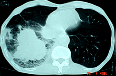 Hình ảnh khối u ác tính có ranh gới không rõ với nhiều chân bám xung quanh dạng càng cua trên phim chụp CT ngực ở của sổ nhu mô