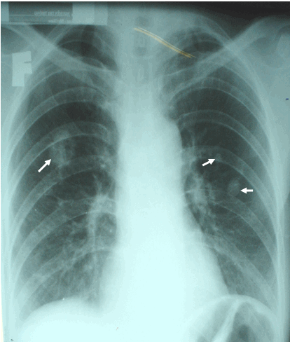 Hình ảnh ung thư thứ phát kiểu thả bóng trên phim chụp phổi thẳng ở bệnh nhân nữ, 49 tuổi  Ung thư phổi thứ phát