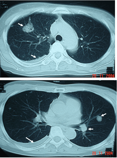 Hình ảnh ung thư phổi thứ phát kiểu thả bóng, tràn dịch màng phổi phải trên CT ngực ở cùng bệnh nhân, 49 tuổi - Ung thư phổi thứ phát