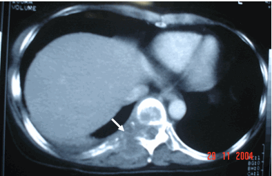Hình ảnh ung thư di căn cột sống trên phim CT ngực ở cùng bệnh nhân, 49 tuổi - Ung thư phổi & cột sống thứ phát