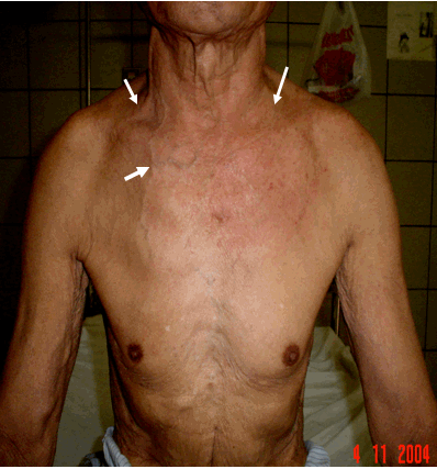 Hình ảnh phù áo khoác & tuần hoàn bàng hệ ở ngực trong hội chứng trung thất (hố thượng đòn 2 bên đầy hai mũi tên trắng giữa. Tuần hoàn bàng hệ ở ngực - mũi tên trắng dưới