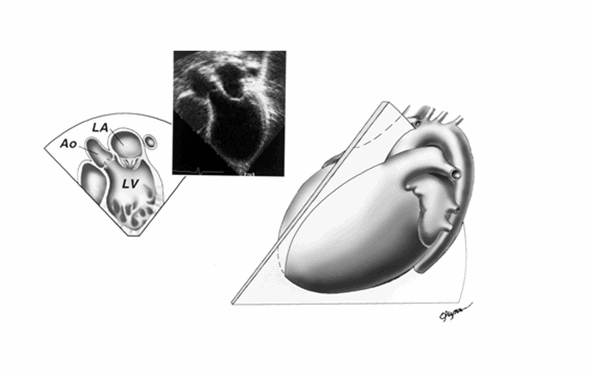 Bước 4. Mặt cắt 3 buồng tim từ mỏm. Tâm nhĩ trái (LA), tâm thất trái (LV) và đường ra, động mạch chủ (Ao).