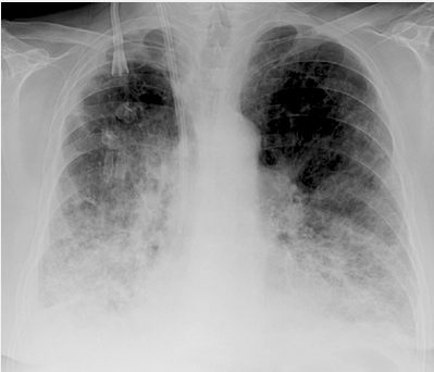 Hình. Viêm phổi bệnh viện (Nosocomial)